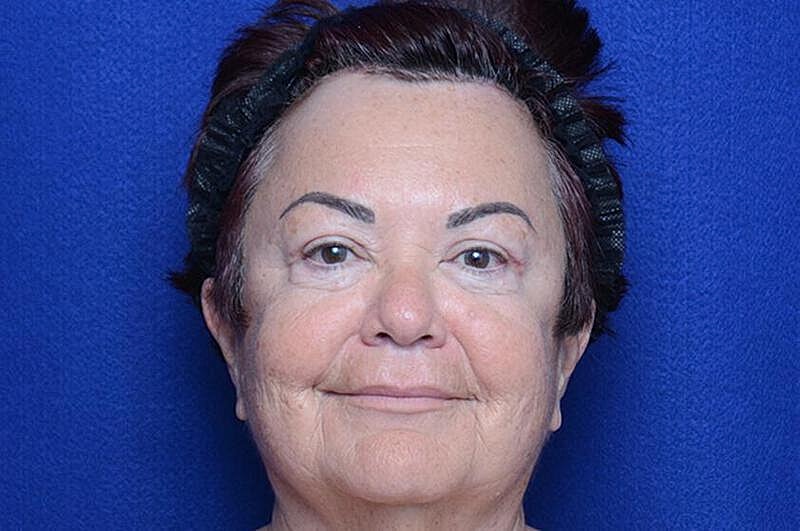 Upper Blepharoplasty Before & After
