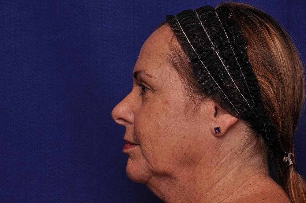 Upper Blepharoplasty Before & After