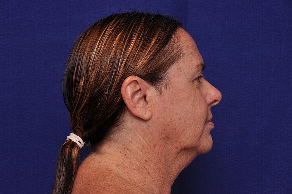 Upper Blepharoplasty Before & After