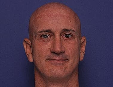 Upper Blepharoplasty Before & After