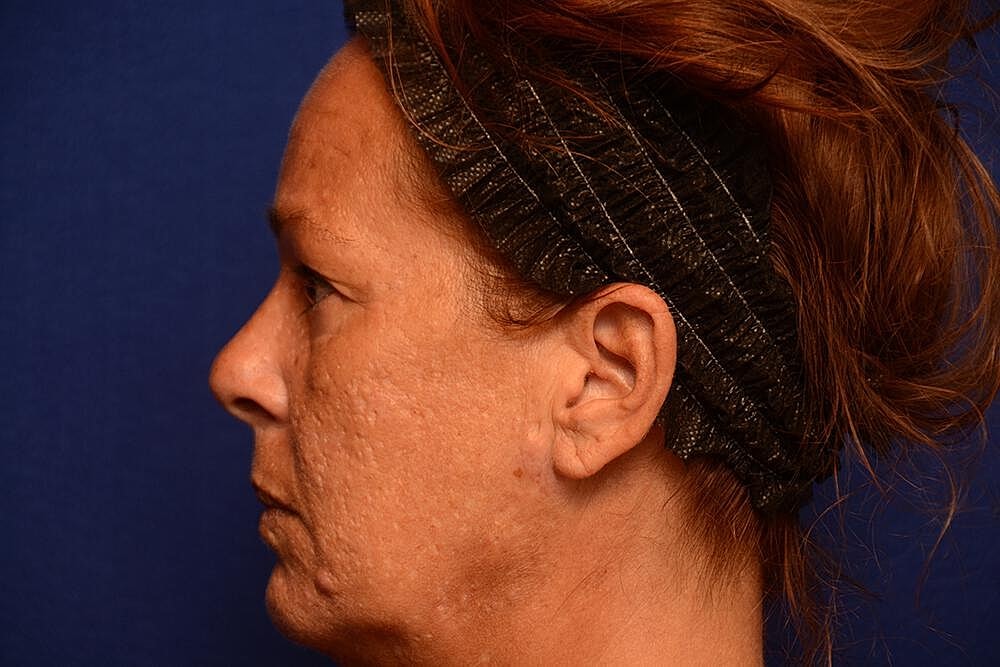 Upper Blepharoplasty Before & After