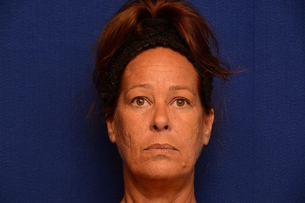 Upper Blepharoplasty Before & After