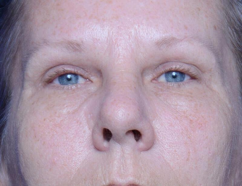 Upper Blepharoplasty Before & After
