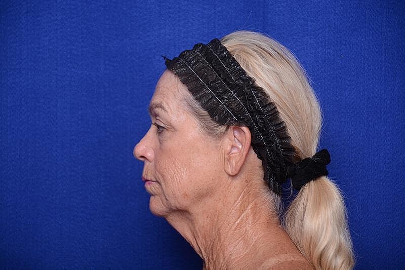 Upper Blepharoplasty Before & After