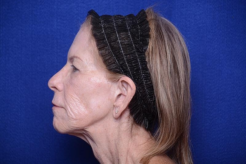 Upper Blepharoplasty Before & After