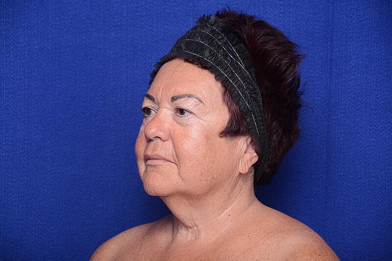 Upper Blepharoplasty Before & After