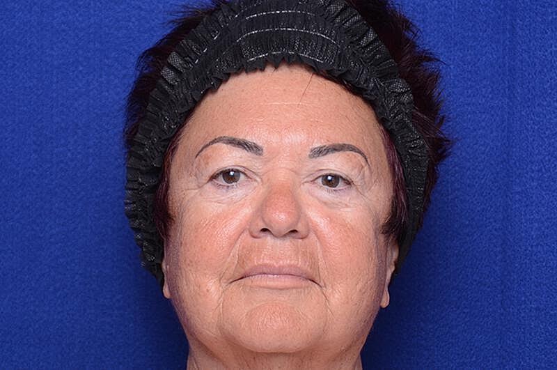 Upper Blepharoplasty Before & After