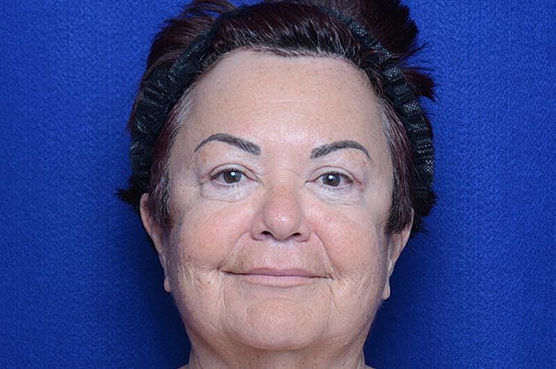 Upper Blepharoplasty Before & After