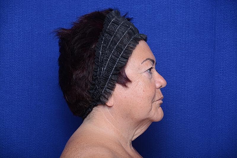 Upper Blepharoplasty Before & After