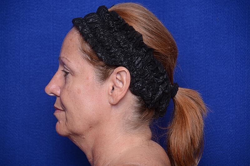 Upper Blepharoplasty Before & After