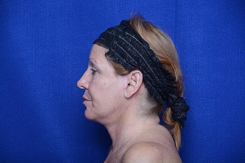 Upper Blepharoplasty Before & After