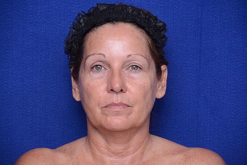 Upper Blepharoplasty Before & After