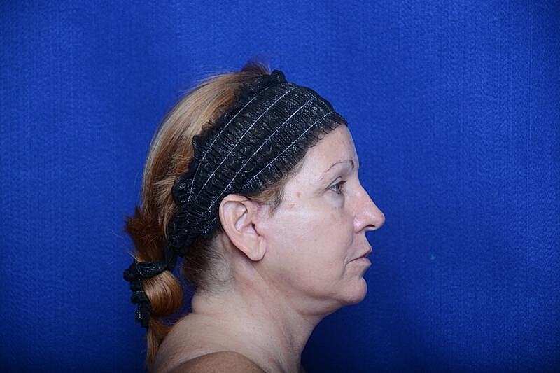 Upper Blepharoplasty Before & After