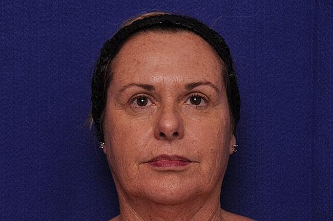 Upper Blepharoplasty Before & After
