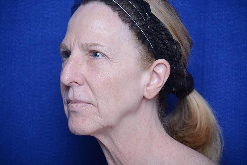 Upper Blepharoplasty Before & After