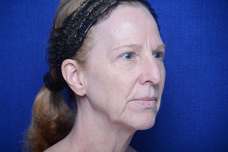 Upper Blepharoplasty Before & After