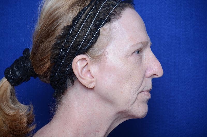 Upper Blepharoplasty Before & After