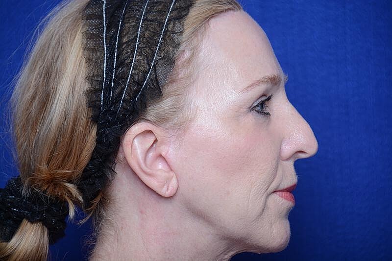 Upper Blepharoplasty Before & After