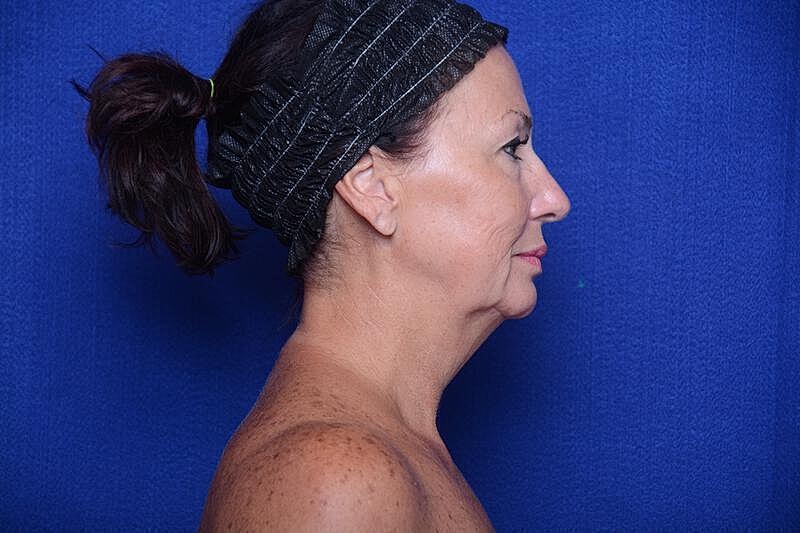 Upper Blepharoplasty Before & After