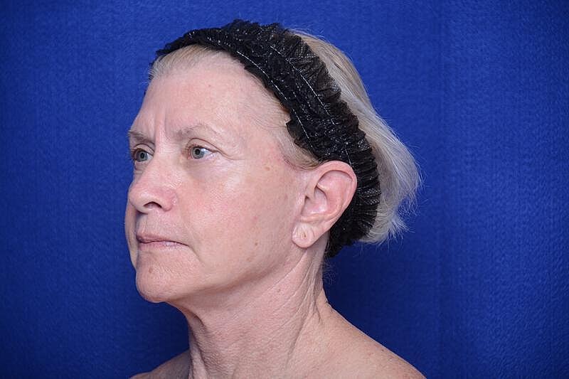 Upper Blepharoplasty Before & After