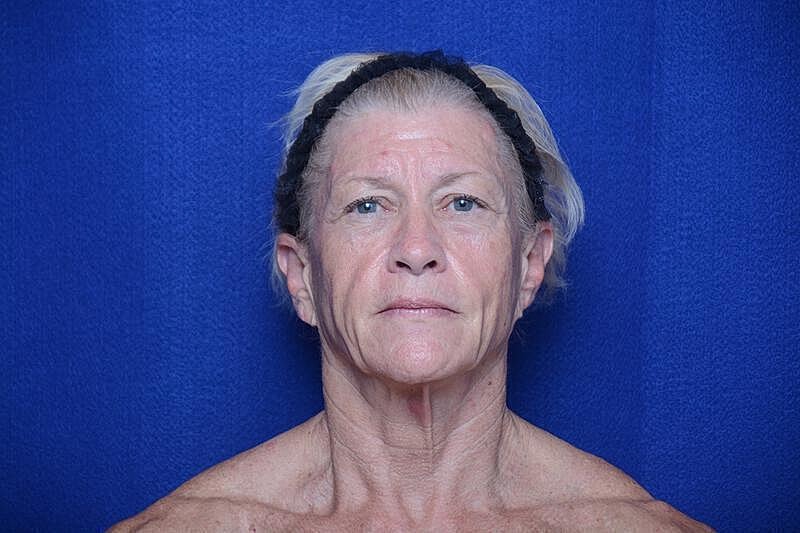 Upper Blepharoplasty Before & After