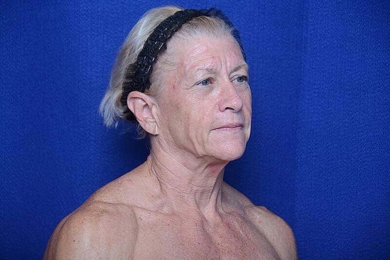 Upper Blepharoplasty Before & After