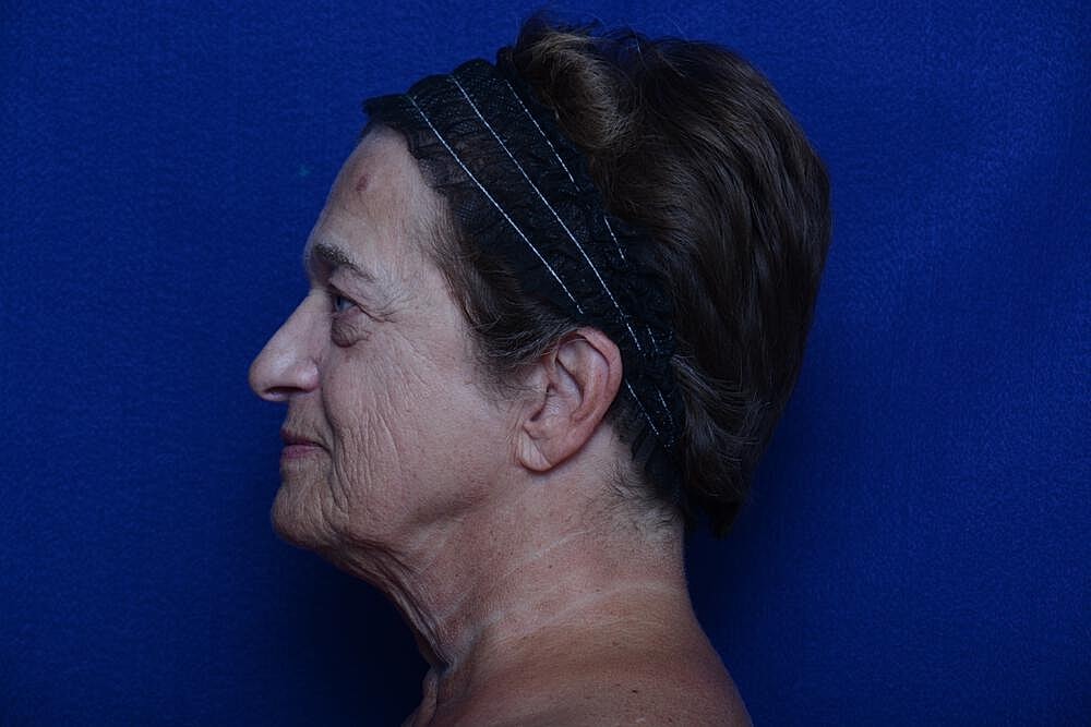 Upper Blepharoplasty Before & After