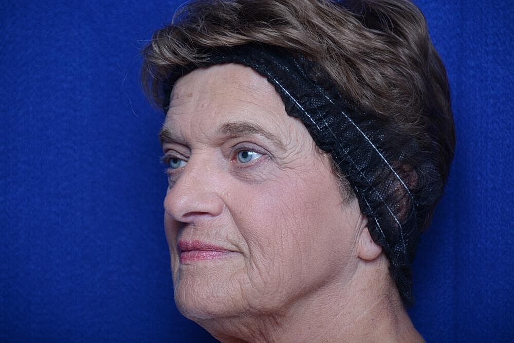 Upper Blepharoplasty Before & After