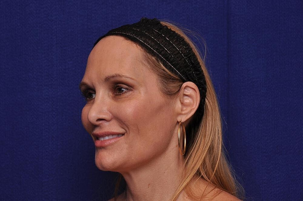 Upper Blepharoplasty Before & After