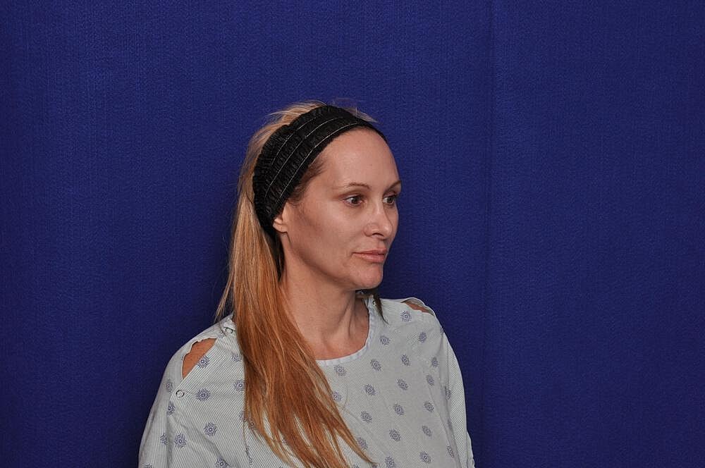 Upper Blepharoplasty Before & After