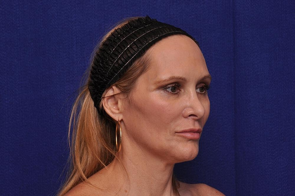 Upper Blepharoplasty Before & After