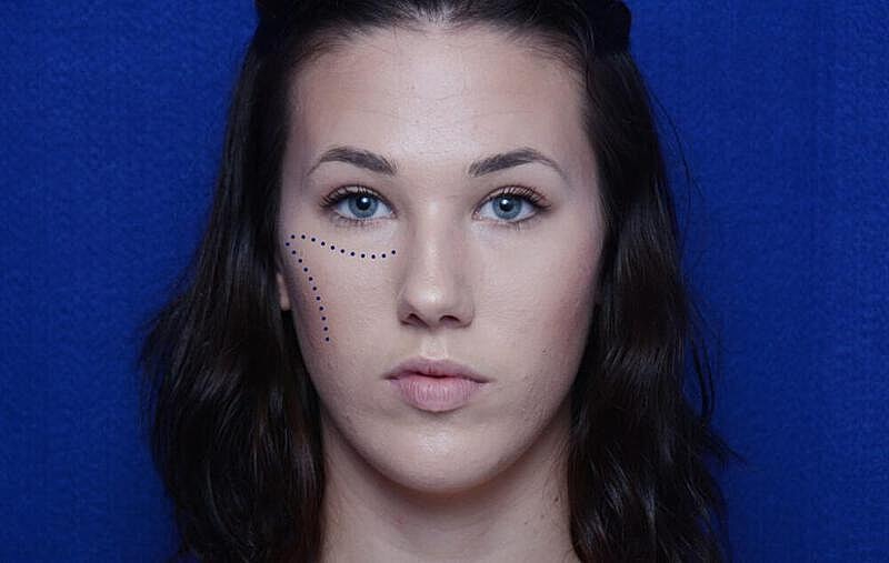 Injectable Cheek Lift Before & After