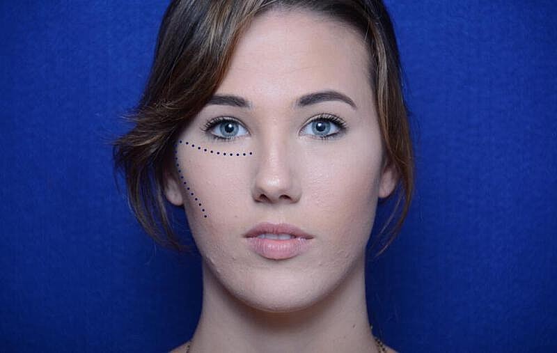 Injectable Cheek Lift Before & After