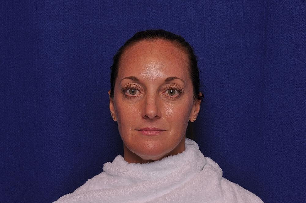 Injectable Cheek Lift Before & After