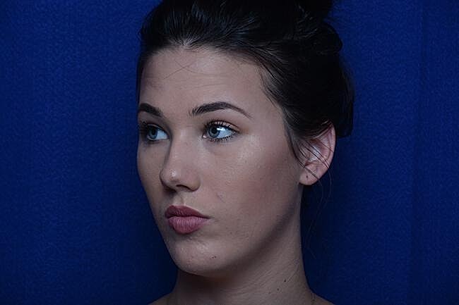 Injectable Cheek Lift Before & After