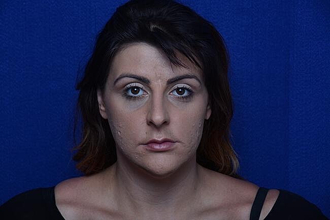 Injectable Cheek Lift Before & After