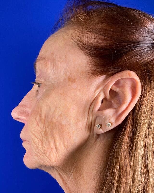 Injectable Cheek Lift Before & After