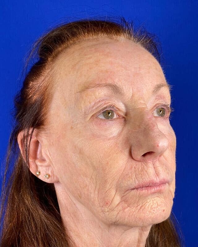 Injectable Cheek Lift Before & After
