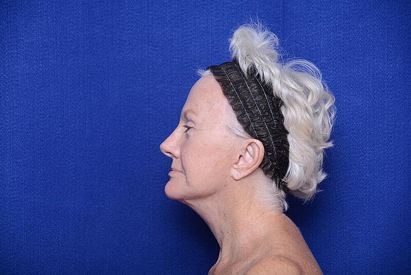 Lower Blepharoplasty Before & After