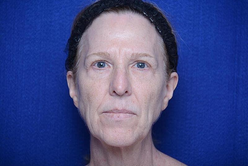 Lower Blepharoplasty Before & After