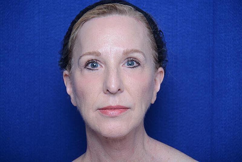 Lower Blepharoplasty Before & After