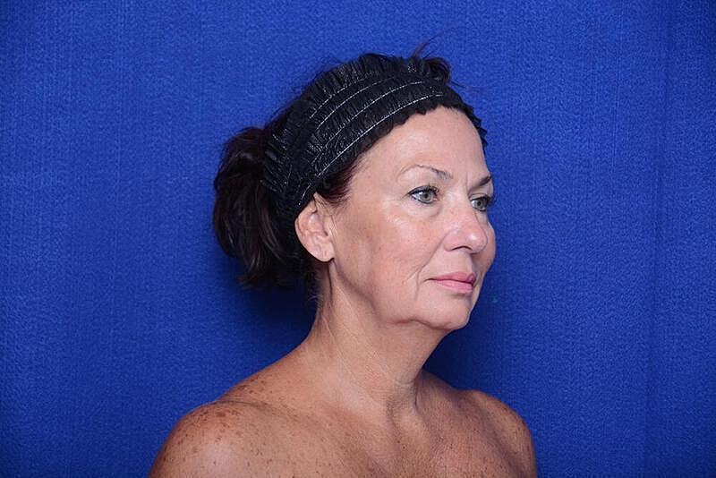 Lower Blepharoplasty Before & After