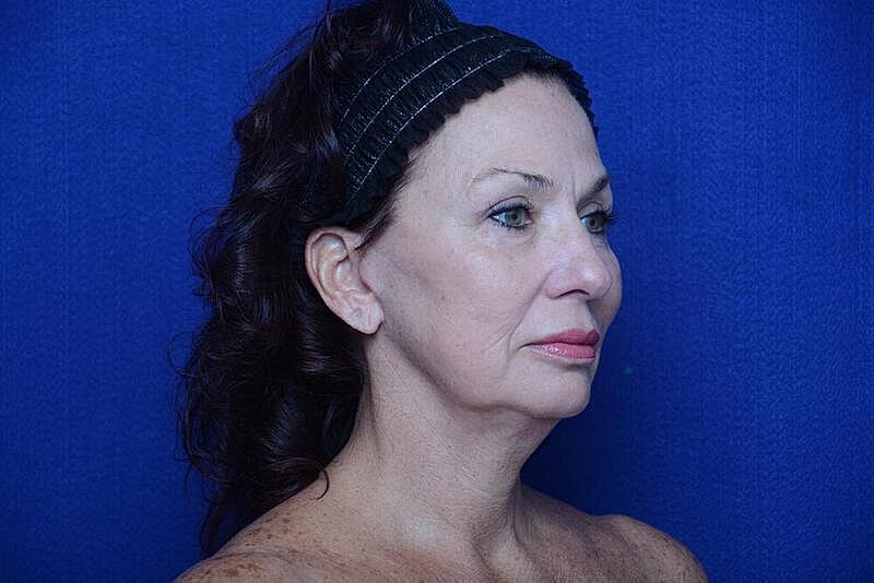 Lower Blepharoplasty Before & After