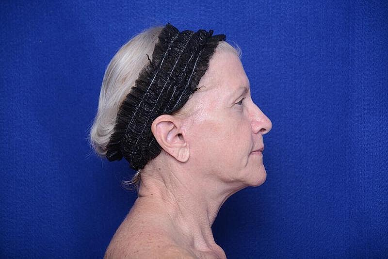 Lower Blepharoplasty Before & After