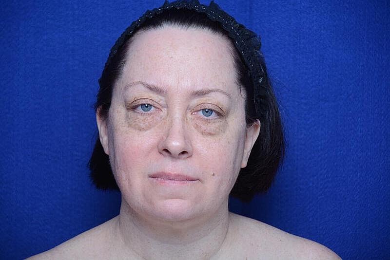 Lower Blepharoplasty Before & After
