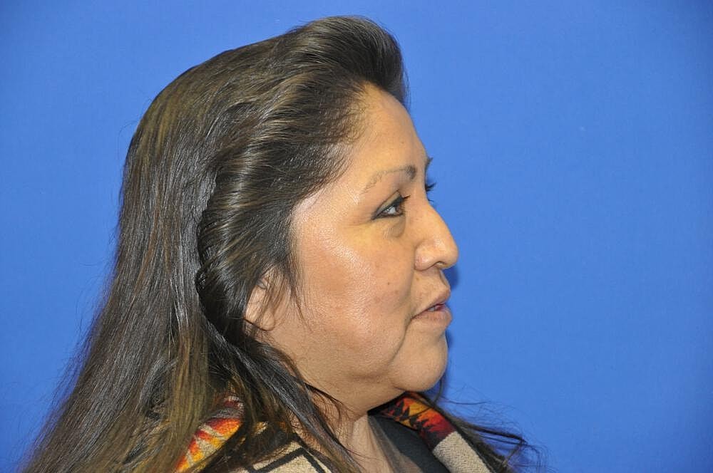 Lower Blepharoplasty Before & After