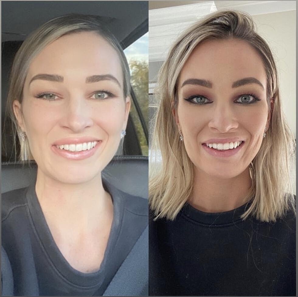 Botox For Bells Palsy Before & After