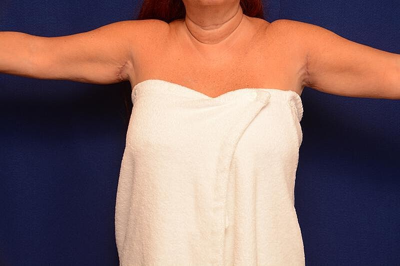 Arm Lift Before & After