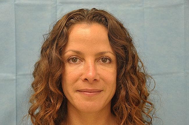 Botox Before & After