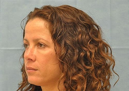 Botox Before & After